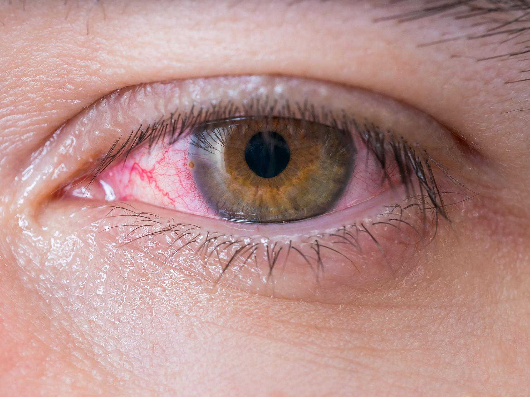 該圖片顯示了一隻不健康眼睛的特寫，說明了潛在的眼睛危害的外觀。 