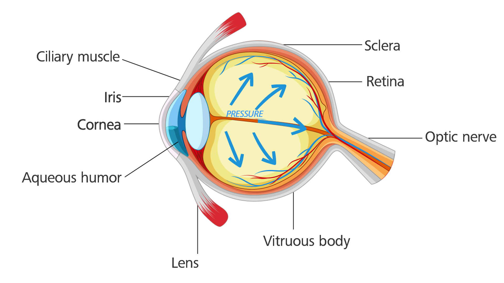 罹患青光眼的眼睛：眼壓上升，造成視神經受損。